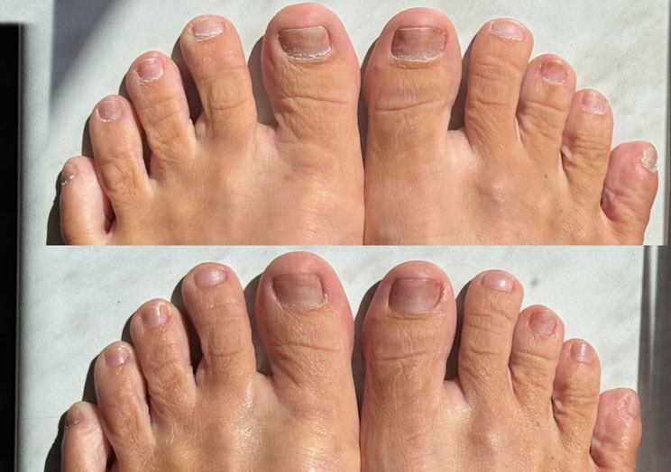Žaneta’s toes—softer, hydrated results after using MOLOSOC
