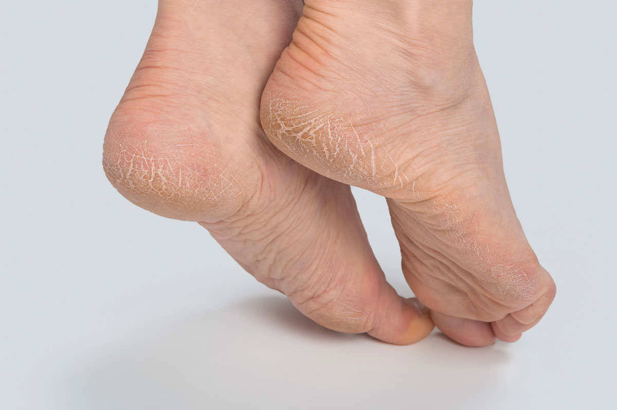 Before - cracked dry feet