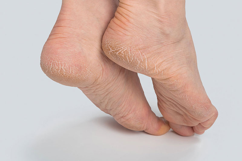 Moisture-Lock-Nitrile-Foot-Covers-Image-Molosoc-Cracked-feet1
